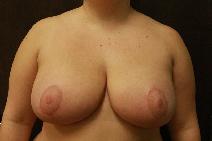 Breast Reduction After Photo by Paul Rhee, MD, FACS; Castle Rock, CO - Case 9079