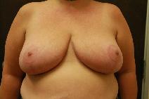 Breast Reduction After Photo by Paul Rhee, MD, FACS; Castle Rock, CO - Case 9211