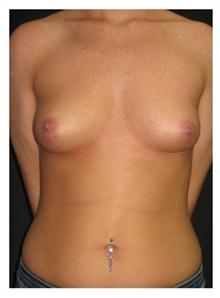 Breast Augmentation Before Photo by George Bitar, MD; ,  - Case 25885