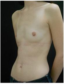 Breast Augmentation Before Photo by George Bitar, MD; Fairfax, VA - Case 25887
