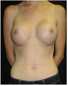 Breast Augmentation After Photo by George Bitar, MD; Fairfax, VA - Case 25887