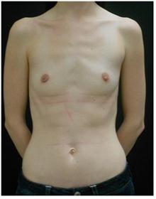 Breast Augmentation Before Photo by George Bitar, MD; Fairfax, VA - Case 25887