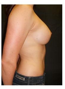 Breast Augmentation After Photo by George Bitar, MD; Fairfax, VA - Case 25891