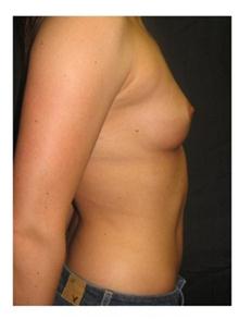 Breast Augmentation Before Photo by George Bitar, MD; Fairfax, VA - Case 25891