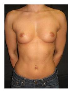 Breast Augmentation Before Photo by George Bitar, MD; Fairfax, VA - Case 25891