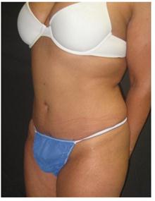 Tummy Tuck After Photo by George Bitar, MD; Fairfax, VA - Case 25893