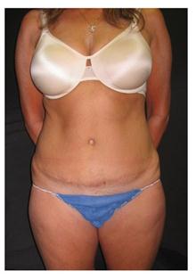 Tummy Tuck After Photo by George Bitar, MD; Fairfax, VA - Case 25896