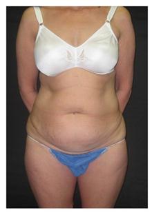 Tummy Tuck Before Photo by George Bitar, MD; Fairfax, VA - Case 25896