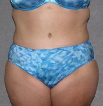 Tummy Tuck After Photo by David Kupfer, MD; San Diego, CA - Case 7222