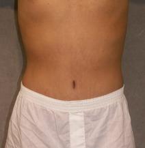 Tummy Tuck After Photo by David Kupfer, MD; San Diego, CA - Case 7223