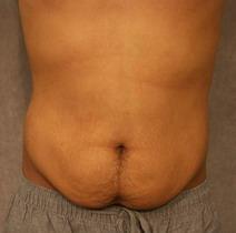 Tummy Tuck Before Photo by David Kupfer, MD; San Diego, CA - Case 7223