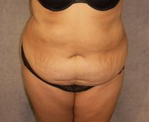 Tummy Tuck Before Photo by David Kupfer, MD; San Diego, CA - Case 7231