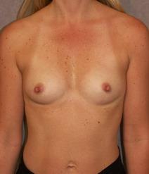 Breast Augmentation Before Photo by David Kupfer, MD; San Diego, CA - Case 7234