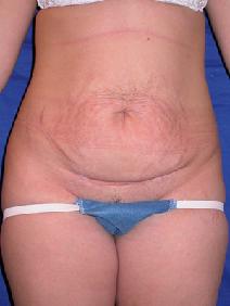 Tummy Tuck Before Photo by Joseph Poggi, MD; Wichita, KS - Case 8123