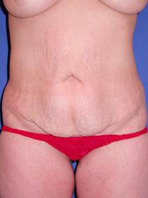 Tummy Tuck Before Photo by Joseph Poggi, MD; Wichita, KS - Case 8125