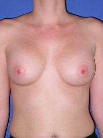 Breast Augmentation After Photo by Joseph Poggi, MD; Wichita, KS - Case 8137
