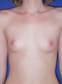 Breast Augmentation Before Photo by Joseph Poggi, MD; Wichita, KS - Case 8137