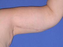Arm Lift After Photo by Joseph Poggi, MD; Wichita, KS - Case 8138