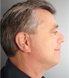 Facelift After Photo by Ellen Mahony, MD; Westport, CT - Case 39559