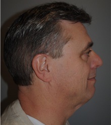 Facelift Before Photo by Ellen Mahony, MD; Westport, CT - Case 39559