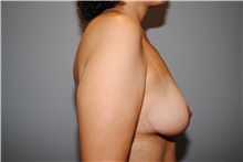 Breast Lift After Photo by Ellen Mahony, MD; Westport, CT - Case 39655