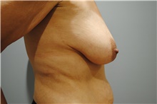 Breast Lift Before Photo by Ellen Mahony, MD; Westport, CT - Case 39655