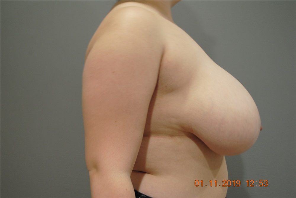 Breast Reduction Before and After Photos by Ellen Mahony, MD