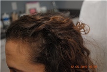 Hair Transplant After Photo by Ellen Mahony, MD; Westport, CT - Case 40950