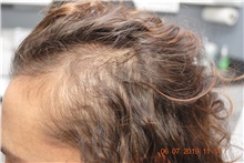 Hair Transplant Before Photo by Ellen Mahony, MD; Westport, CT - Case 40950