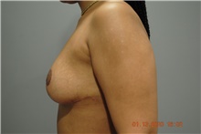 Breast Lift After Photo by Ellen Mahony, MD; Westport, CT - Case 40951