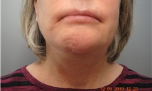 Facelift After Photo by Ellen Mahony, MD; Westport, CT - Case 41435