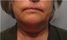 Facelift Before Photo by Ellen Mahony, MD; Westport, CT - Case 41435