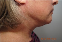 Facelift After Photo by Ellen Mahony, MD; Westport, CT - Case 41435