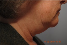 Facelift Before Photo by Ellen Mahony, MD; Westport, CT - Case 41435