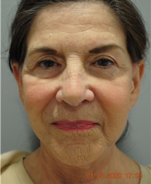 Facelift After Photo by Ellen Mahony, MD; Westport, CT - Case 41438