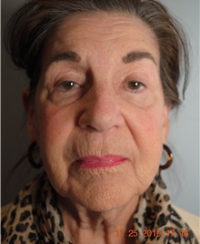 Facelift Before Photo by Ellen Mahony, MD; Westport, CT - Case 41438