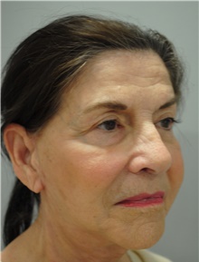 Facelift After Photo by Ellen Mahony, MD; Westport, CT - Case 41438