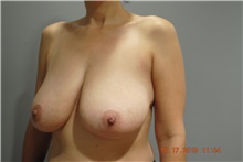 Breast Reduction Before Photo by Ellen Mahony, MD; Westport, CT - Case 41440