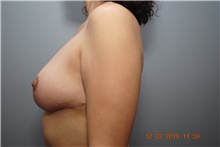 Breast Reduction After Photo by Ellen Mahony, MD; Westport, CT - Case 41440