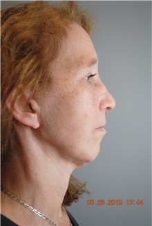 Facelift After Photo by Ellen Mahony, MD; Westport, CT - Case 41442