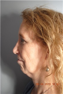 Facelift Before Photo by Ellen Mahony, MD; Westport, CT - Case 41442