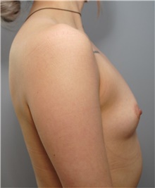 Breast Augmentation Before Photo by Ellen Mahony, MD; Westport, CT - Case 41940