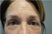 Eyelid Surgery After Photo by Ellen Mahony, MD; Westport, CT - Case 41943