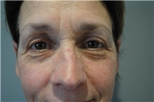 Eyelid Surgery Before Photo by Ellen Mahony, MD; Westport, CT - Case 41943