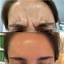 Botulinum Toxin After Photo by Ellen Mahony, MD; Westport, CT - Case 42417