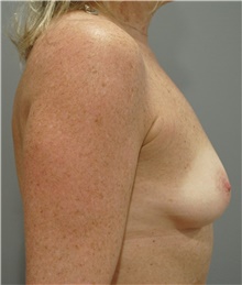 Breast Augmentation Before Photo by Ellen Mahony, MD; Westport, CT - Case 42704
