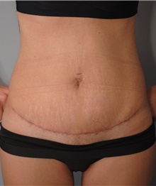 Tummy Tuck After Photo by Ellen Mahony, MD; Westport, CT - Case 42705