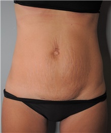 Tummy Tuck Before Photo by Ellen Mahony, MD; Westport, CT - Case 42705