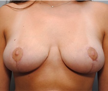 Breast Lift After Photo by Ellen Mahony, MD; Westport, CT - Case 42974