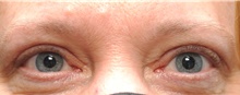 Eyelid Surgery After Photo by Ellen Mahony, MD; Westport, CT - Case 42975